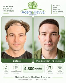 Before and after hair transplant results at Adem and Havva Medical Center, 4,800 grafts used