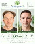 Before and after hair transplant results at Adem and Havva Medical Center, 4,800 grafts used