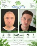 Before and after DHI hair transplant results at Adem and Havva Medical Center, 2800 grafts