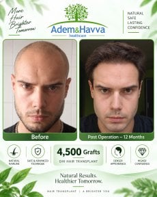 Before and after DHI hair transplant results at Adem and Havva Medical Center, 4500 grafts