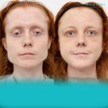 Antes y después de reducción de pómulos en Wansiri Hospital, resultado visible de contorno facial