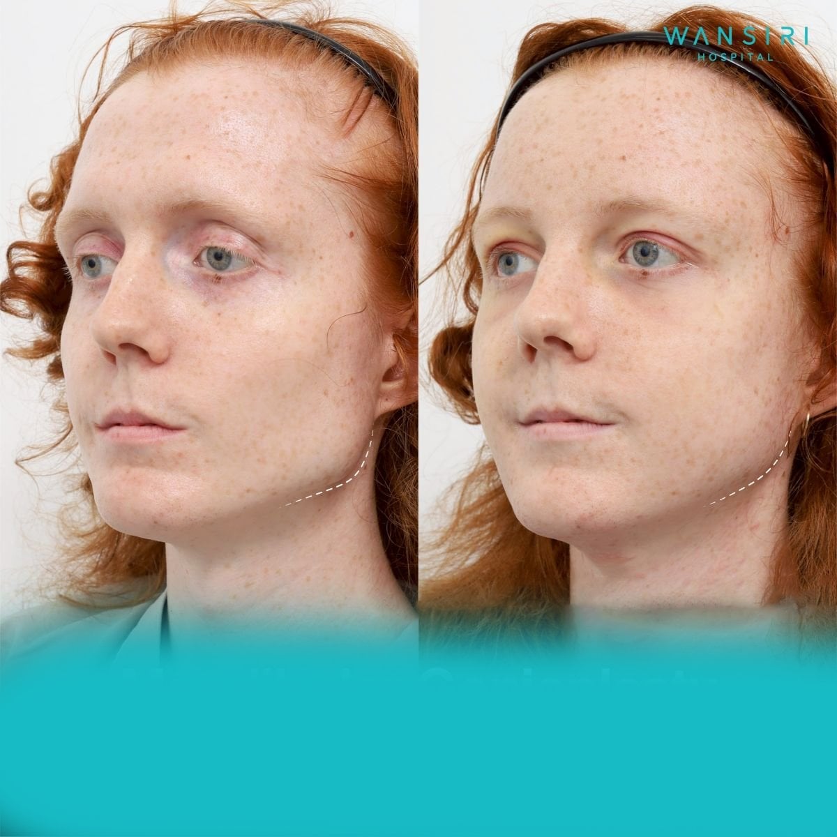 Resultados antes y después de reducción de pómulos en Wansiri Hospital, mejora del contorno facial