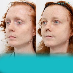 Resultados antes y después de reducción de pómulos en Wansiri Hospital, mejora del contorno facial