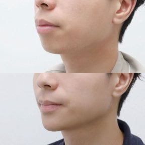 before-after photo jawline-contouring