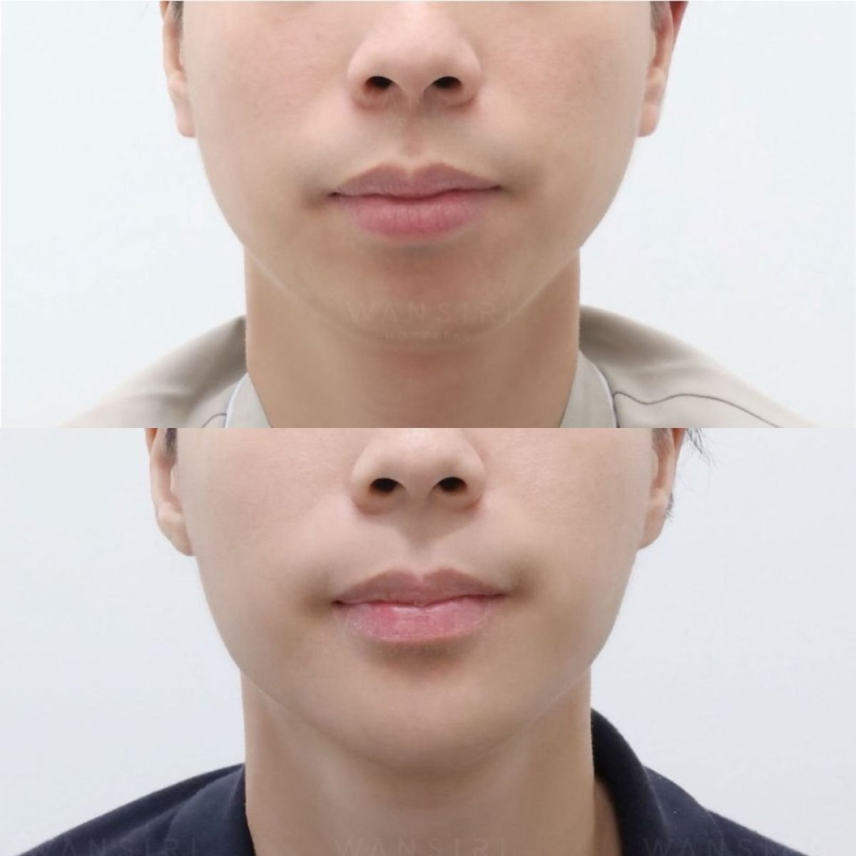 Antes y después de contorno de mandíbula en Wansiri Hospital, resultado de perfil mejorado