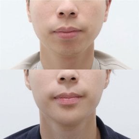 before-after photo jawline-contouring