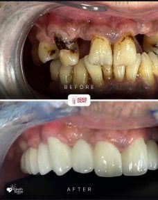 Before and after dental implant results at Ader Dent Oral and Dental Health Polyclinic, smile restoration
