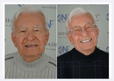 before-after photo full-arch-implant-fixed-complete-dentures-in-monolithic-zirconia-8-titanium-implants