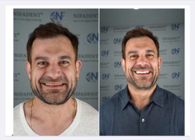 before-after photo full-arch-implant-fixed-complete-dentures-in-monolithic-zirconia-8-titanium-implants