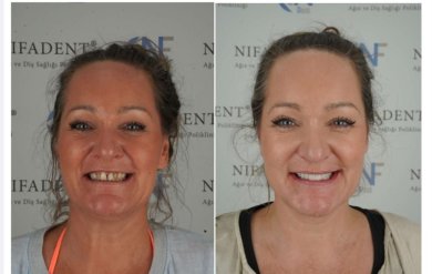 before-after photo full-arch-implant-fixed-complete-dentures-in-monolithic-zirconia-8-titanium-implants
