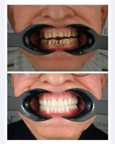 before-after photo full-arch-implant-fixed-complete-dentures-in-monolithic-zirconia-8-titanium-implants