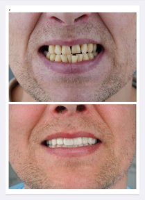 before-after photo full-arch-implant-fixed-complete-dentures-in-monolithic-zirconia-8-titanium-implants