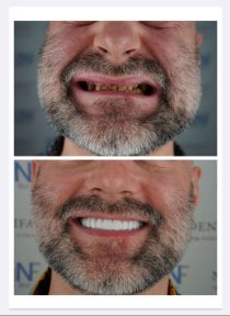 before-after photo full-arch-implant-fixed-complete-dentures-in-monolithic-zirconia-8-titanium-implants