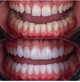 before-after photo full-arch-implant-fixed-complete-dentures-in-monolithic-zirconia-8-titanium-implants