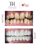 نتائج زراعة الأسنان قبل وبعد في عيادة TH Dental Clinic – ابتسامة مستعادة
