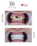 نتائج زراعة الأسنان قبل وبعد في عيادة TH Dental Clinic – استعادة الابتسامة بالكامل
