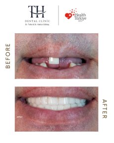 نتائج زراعة الأسنان قبل وبعد في عيادة TH Dental Clinic – ابتسامة مستعادة