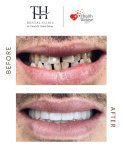نتائج زراعة الأسنان قبل وبعد في عيادة TH Dental Clinic – ابتسامة وأسنان متناسقة