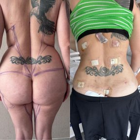before-after photo thigh-lift