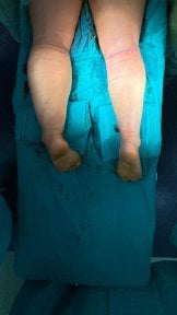 before-after photo thigh-lift