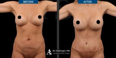 before-after photo abdominoplasty