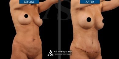 before-after photo abdominoplasty
