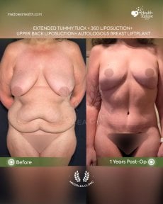 before-after photo abdominoplasty