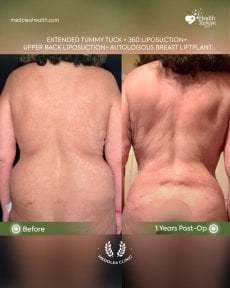 before-after photo abdominoplasty