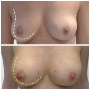 before-after photo breast-implants-with-breast-lift