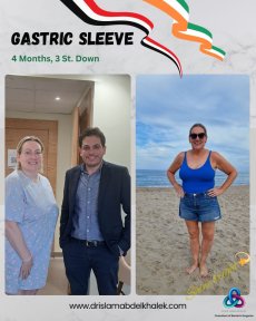 before-after photo roux-en-y-gastric-bypass