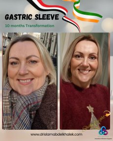 before-after photo roux-en-y-gastric-bypass