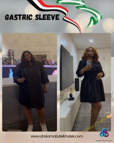 before-after photo roux-en-y-gastric-bypass