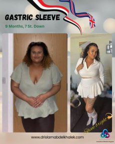before-after photo roux-en-y-gastric-bypass