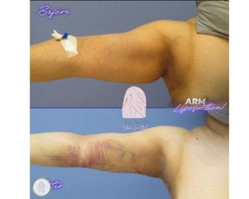 before-after photo podtyazhka-s-pomoshchyu-renuvion-j-plasma