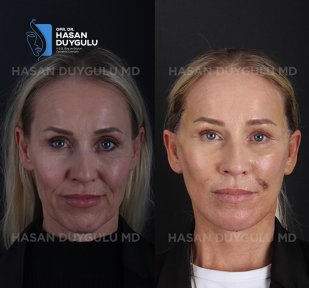 before-after photo rhinoplasty-nose-job