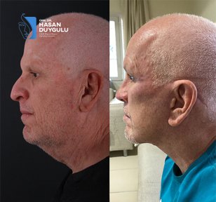 before-after photo rhinoplasty-nose-job