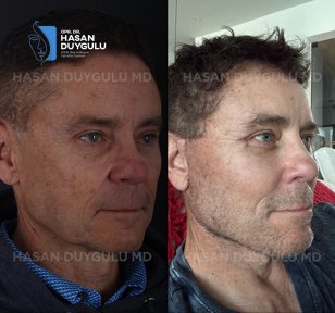 before-after photo rhinoplasty-nose-job