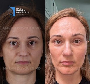 before-after photo rhinoplasty-nose-job