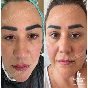 before-after photo thigh-lift