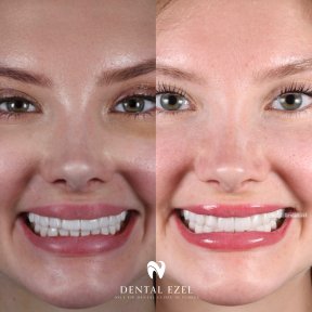 Before and after veneers result at Dental Ezel – smile transformation with whiter teeth