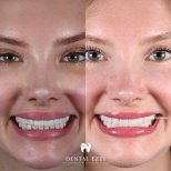 Before and after veneers result at Dental Ezel – smile transformation with whiter teeth