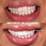 Before and after Emax veneers result, no teeth shaving, smile transformation at Dental Ezel