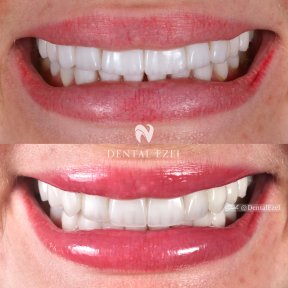 Before and after veneers at Dental Ezel clinic, smile makeover with natural-looking results