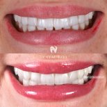 Before and after veneers at Dental Ezel clinic, smile makeover with natural-looking results