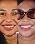 Before and after veneers result at Dental Ezel clinic – smile makeover with whiter teeth