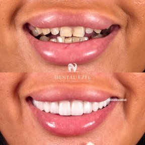 Before and after veneers at Dental Ezel clinic – smile transformation with natural results