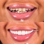 Before and after veneers at Dental Ezel clinic – smile transformation with natural results
