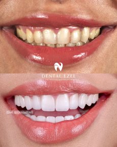 Before and after veneers at Dental Ezel – smile transformation with whiter, even teeth result