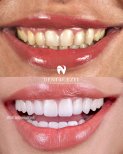 Before and after veneers at Dental Ezel – smile transformation with whiter, even teeth result