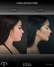 before-after photo liposuction-of-the-second-chin